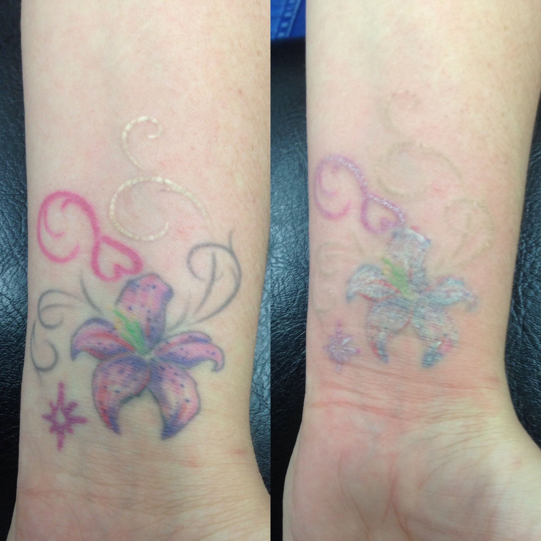Laser Tattoo Removal Near Me