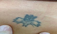 tattoo remove in birmingham