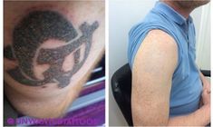 remove unwanted tattoo