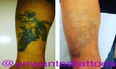 remove unwanted tattoo