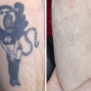 tattoo removal methods